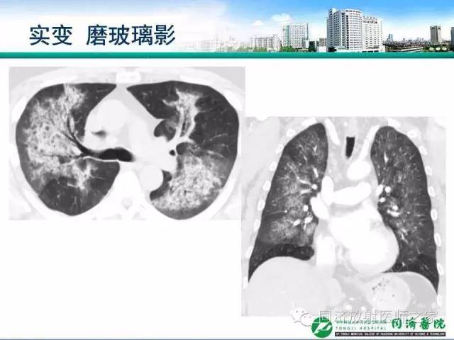 【PPT】肉芽肿性多发血管炎的胸部MSCT特征