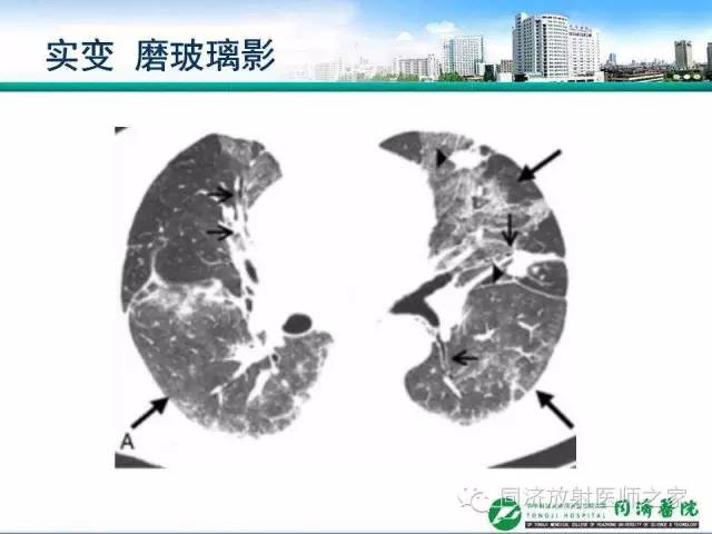 【PPT】肉芽肿性多发血管炎的胸部MSCT特征