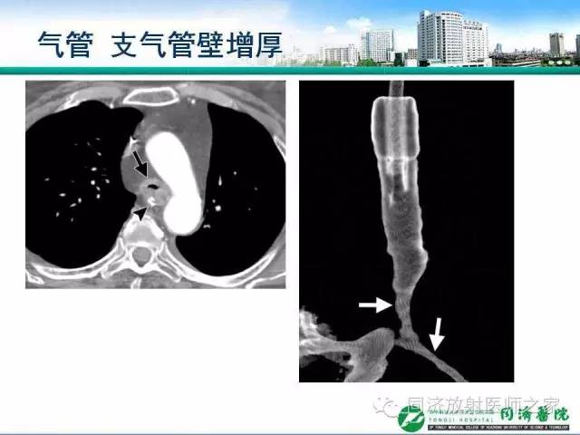 【PPT】肉芽肿性多发血管炎的胸部MSCT特征