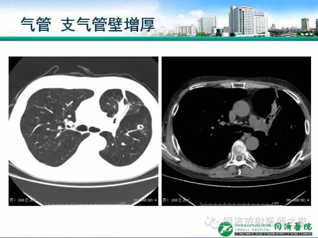 【PPT】肉芽肿性多发血管炎的胸部MSCT特征