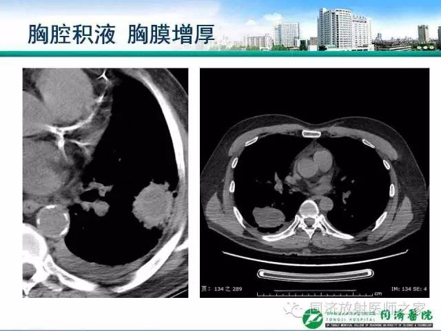 【PPT】肉芽肿性多发血管炎的胸部MSCT特征