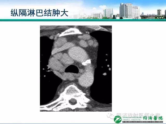 【PPT】肉芽肿性多发血管炎的胸部MSCT特征