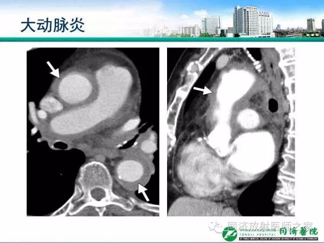 【PPT】肉芽肿性多发血管炎的胸部MSCT特征
