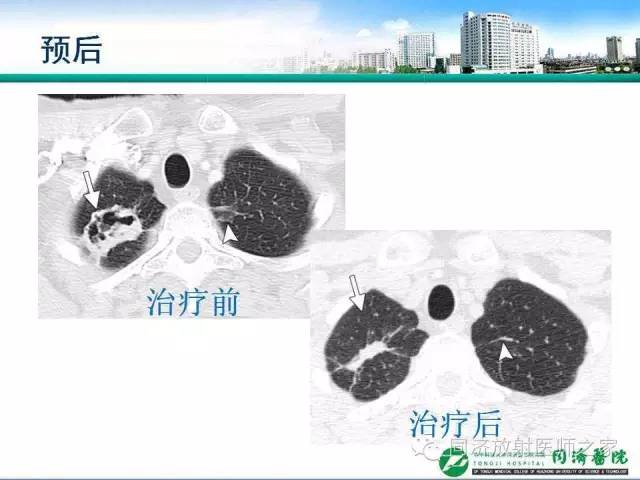 【PPT】肉芽肿性多发血管炎的胸部MSCT特征