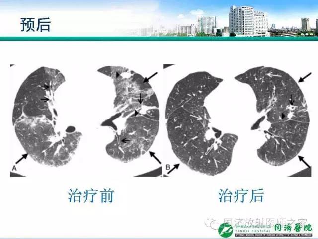 【PPT】肉芽肿性多发血管炎的胸部MSCT特征