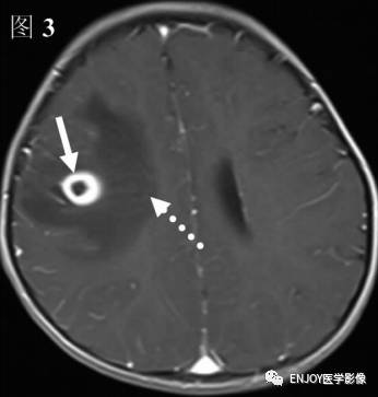 手把手教你会读片:脑囊虫病 手把手教你会读片:脑囊虫病