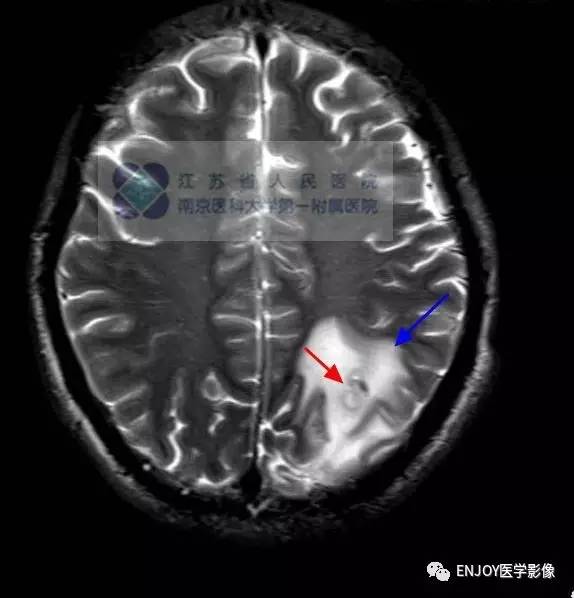 手把手教你会读片:脑囊虫病 手把手教你会读片:脑囊虫病