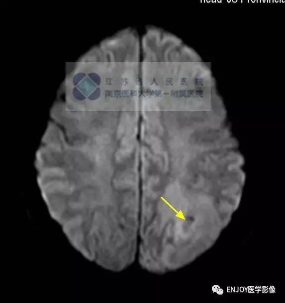 手把手教你会读片:脑囊虫病 手把手教你会读片:脑囊虫病