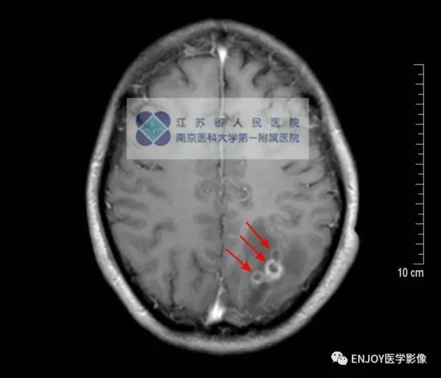 手把手教你会读片:脑囊虫病 手把手教你会读片:脑囊虫病