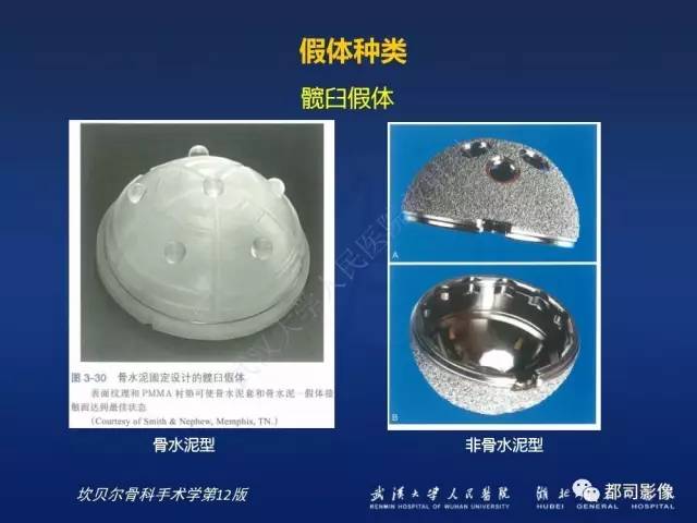 【PPT】髋关节置换术后影像学评价