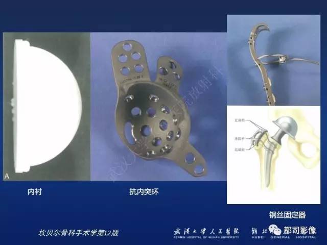 【PPT】髋关节置换术后影像学评价