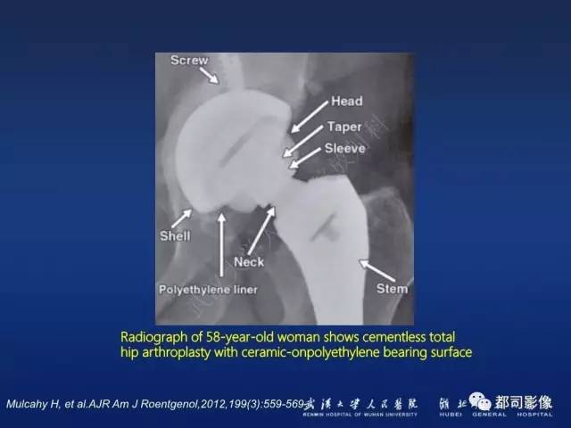 【PPT】髋关节置换术后影像学评价