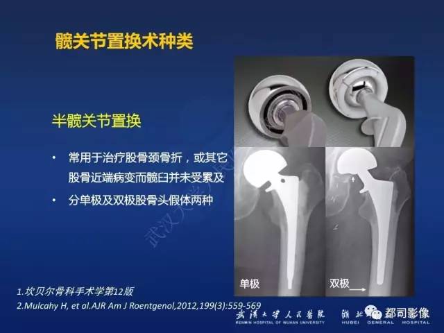 【PPT】髋关节置换术后影像学评价