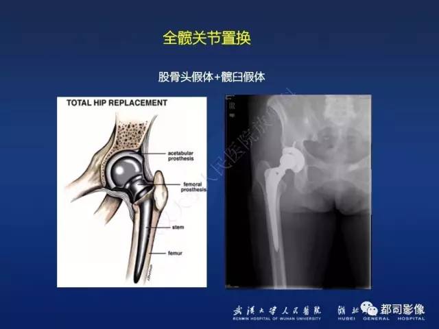 【PPT】髋关节置换术后影像学评价