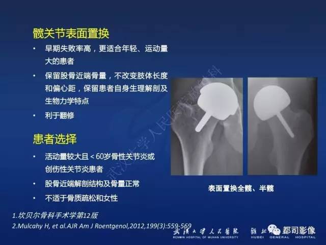 【PPT】髋关节置换术后影像学评价