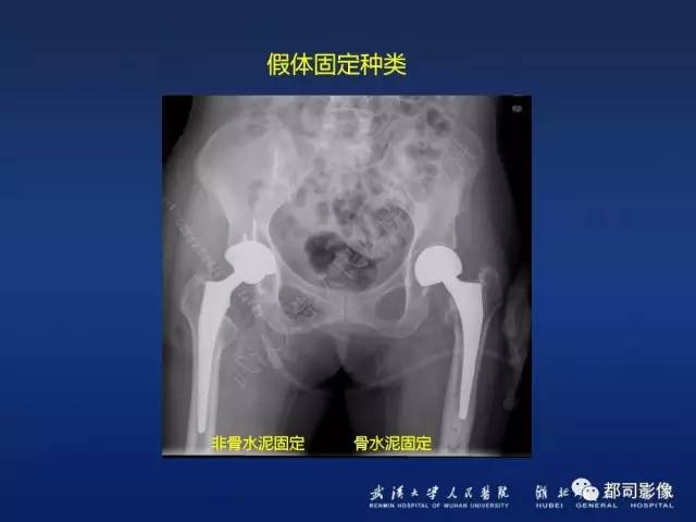 【PPT】髋关节置换术后影像学评价