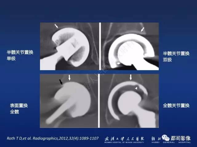 【PPT】髋关节置换术后影像学评价