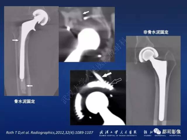 【PPT】髋关节置换术后影像学评价