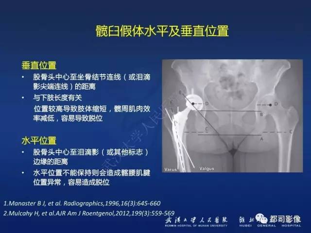 【PPT】髋关节置换术后影像学评价