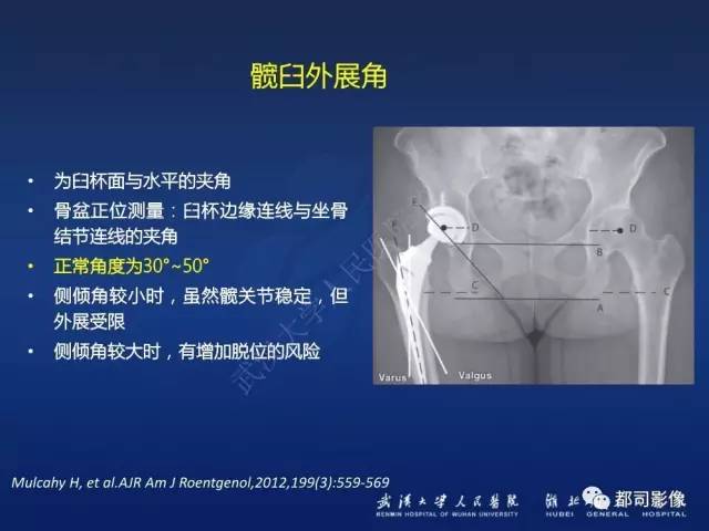 【PPT】髋关节置换术后影像学评价