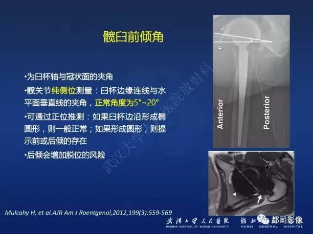 【PPT】髋关节置换术后影像学评价