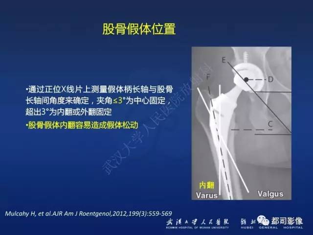 【PPT】髋关节置换术后影像学评价