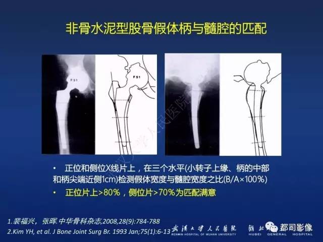 【PPT】髋关节置换术后影像学评价