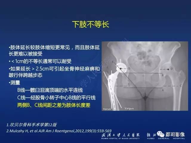 【PPT】髋关节置换术后影像学评价