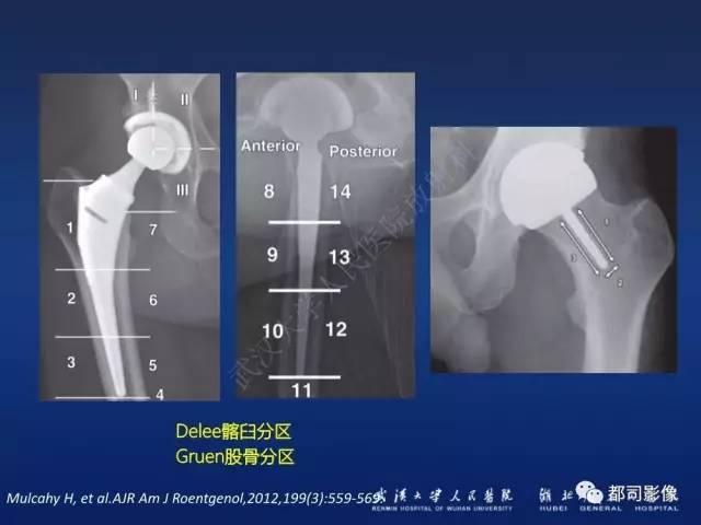 【PPT】髋关节置换术后影像学评价
