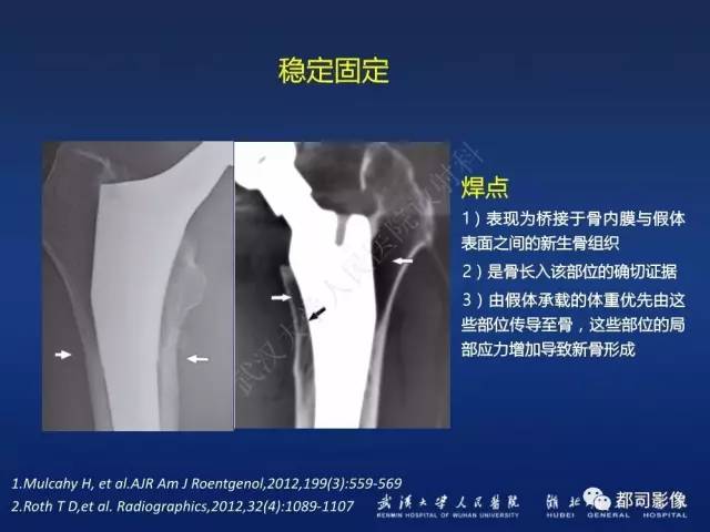 【PPT】髋关节置换术后影像学评价