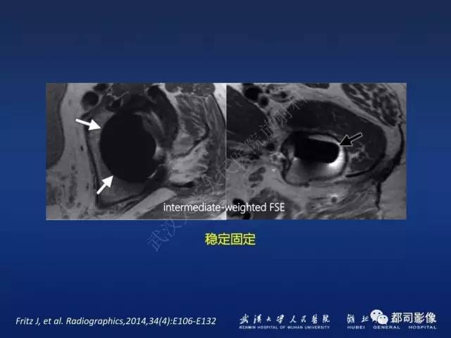 【PPT】髋关节置换术后影像学评价