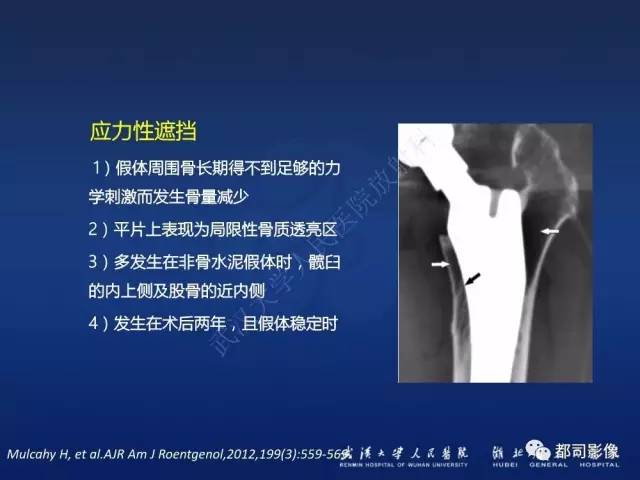 【PPT】髋关节置换术后影像学评价