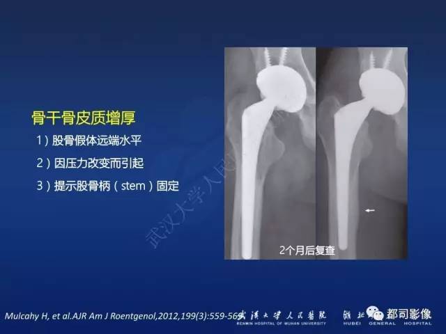 【PPT】髋关节置换术后影像学评价
