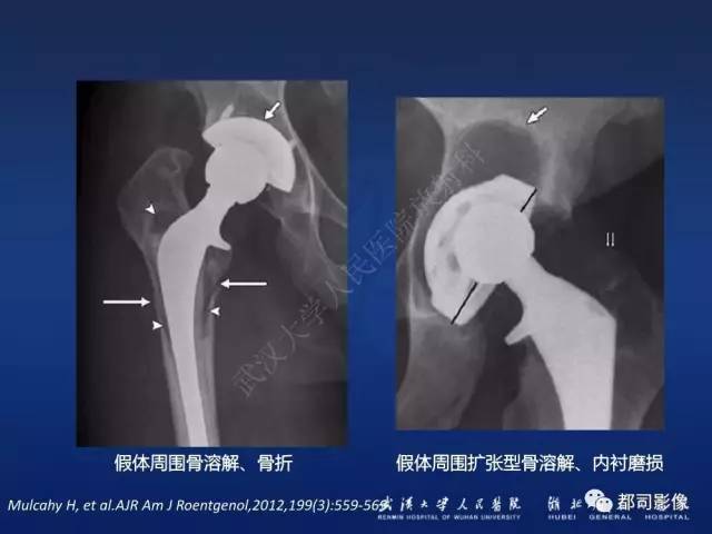 【PPT】髋关节置换术后影像学评价