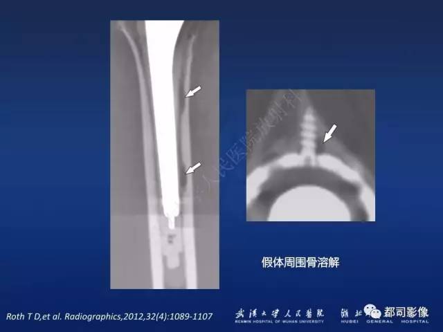 【PPT】髋关节置换术后影像学评价