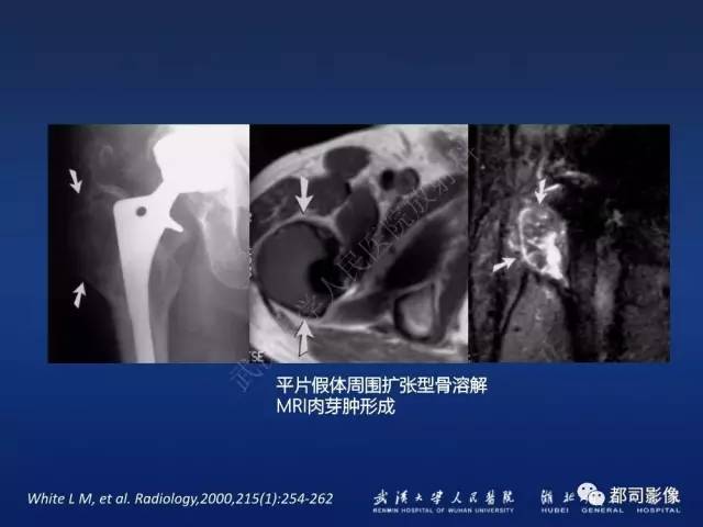 【PPT】髋关节置换术后影像学评价