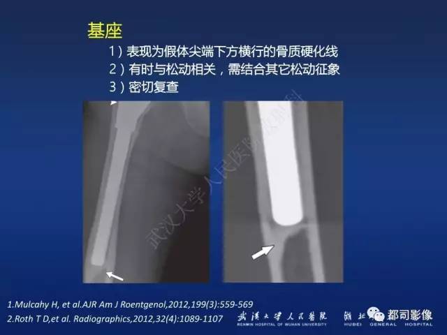【PPT】髋关节置换术后影像学评价