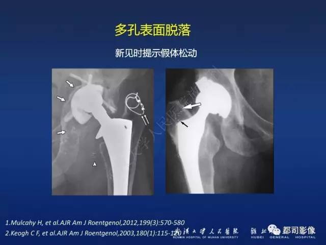 【PPT】髋关节置换术后影像学评价