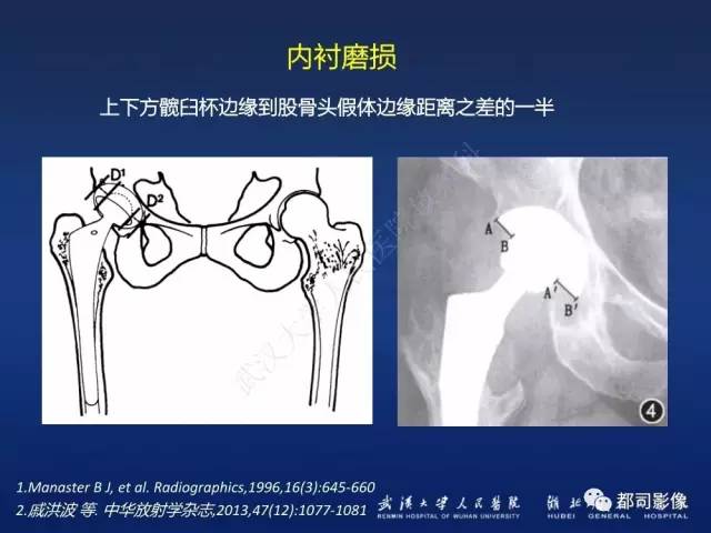 【PPT】髋关节置换术后影像学评价