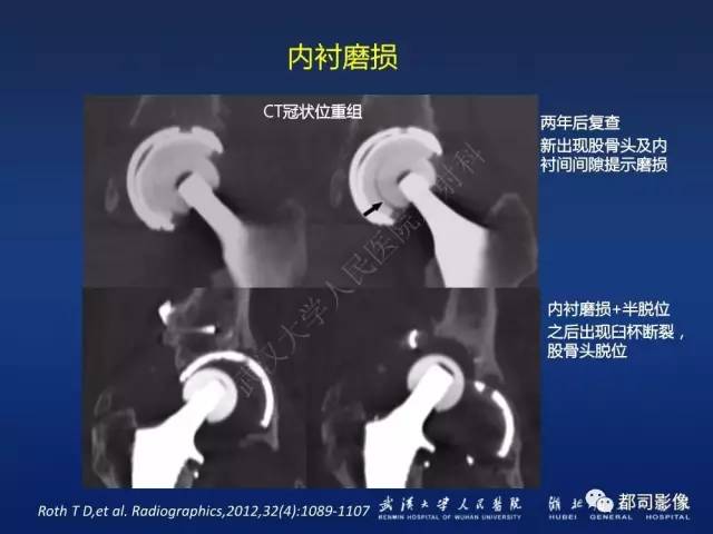 【PPT】髋关节置换术后影像学评价