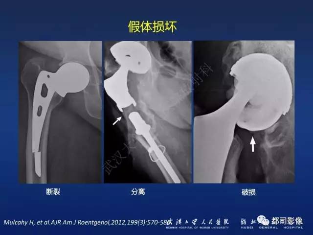 【PPT】髋关节置换术后影像学评价