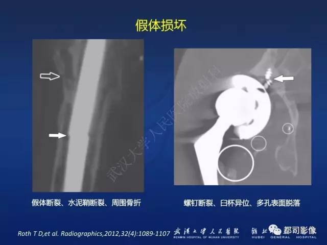 【PPT】髋关节置换术后影像学评价