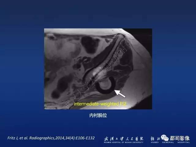 【PPT】髋关节置换术后影像学评价