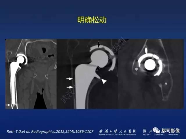 【PPT】髋关节置换术后影像学评价