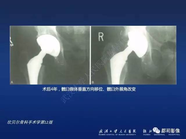 【PPT】髋关节置换术后影像学评价