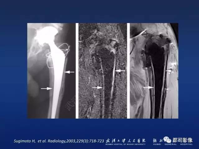 【PPT】髋关节置换术后影像学评价
