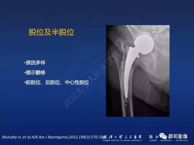 【PPT】髋关节置换术后影像学评价