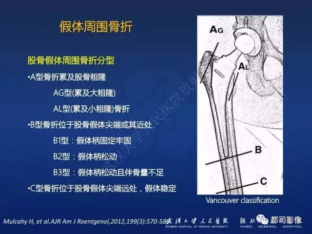 【PPT】髋关节置换术后影像学评价