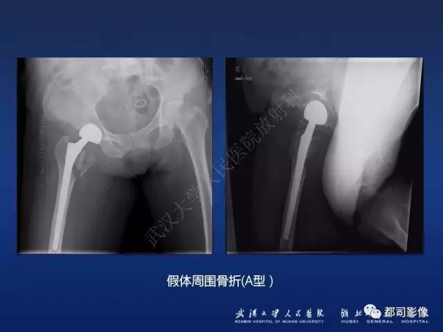 【PPT】髋关节置换术后影像学评价