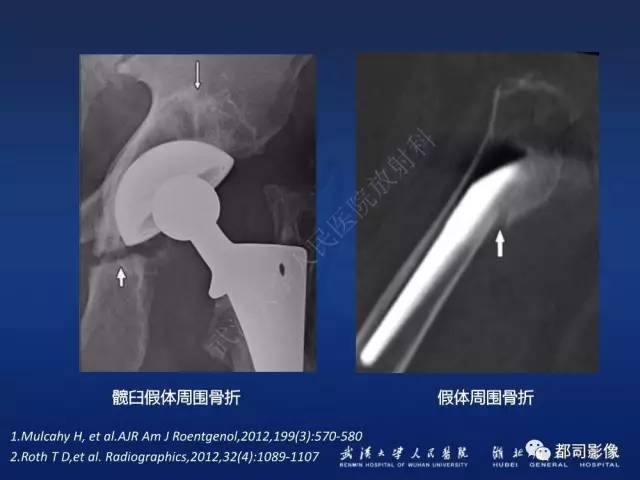 【PPT】髋关节置换术后影像学评价